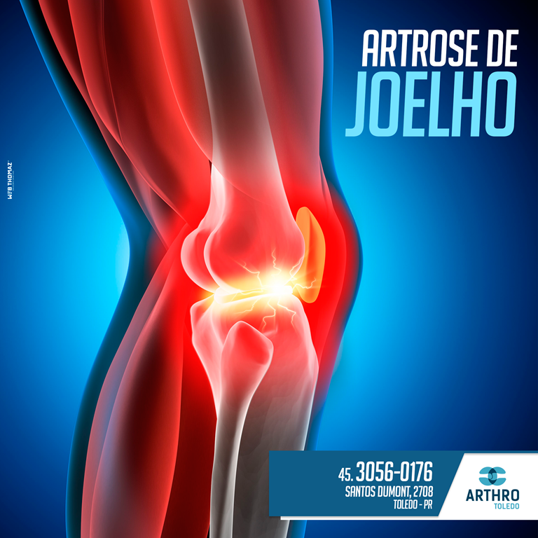 Arthro Ortopedia E Traumatologia Em Toledo Artrose De Joelho